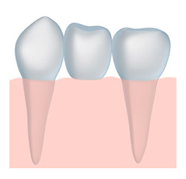 Diagram of a tooth bridge offered by The Carrollton Dentist.